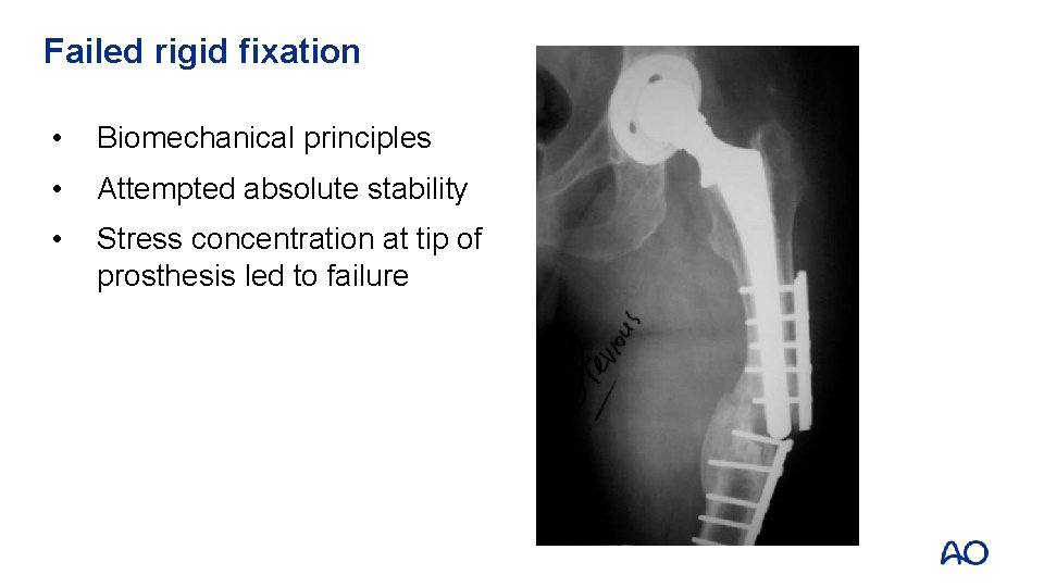Failed rigid fixation • Biomechanical principles • Attempted absolute stability • Stress concentration at