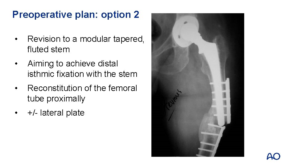 Preoperative plan: option 2 • Revision to a modular tapered, fluted stem • Aiming