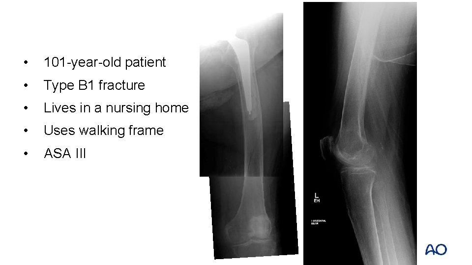  • 101 -year-old patient • Type B 1 fracture • Lives in a