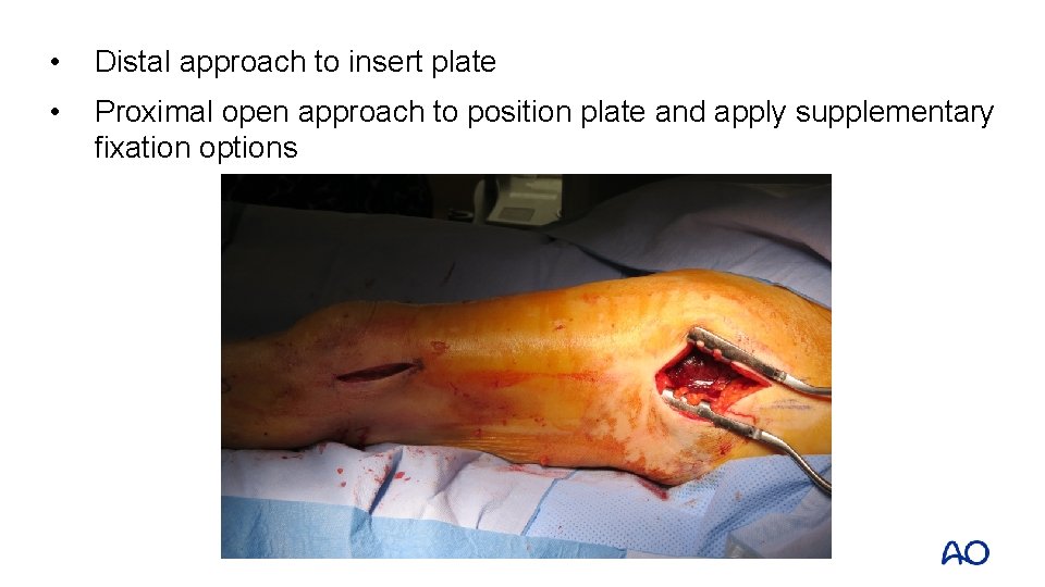  • Distal approach to insert plate • Proximal open approach to position plate