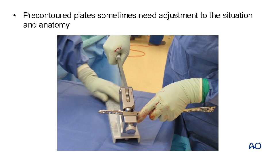  • Precontoured plates sometimes need adjustment to the situation and anatomy 