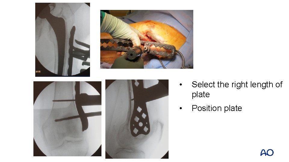  • Select the right length of plate • Position plate 