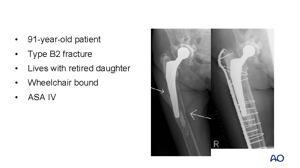  • 91 -year-old patient • Type B 2 fracture • Lives with retired