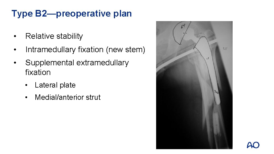 Type B 2—preoperative plan • Relative stability • Intramedullary fixation (new stem) • Supplemental