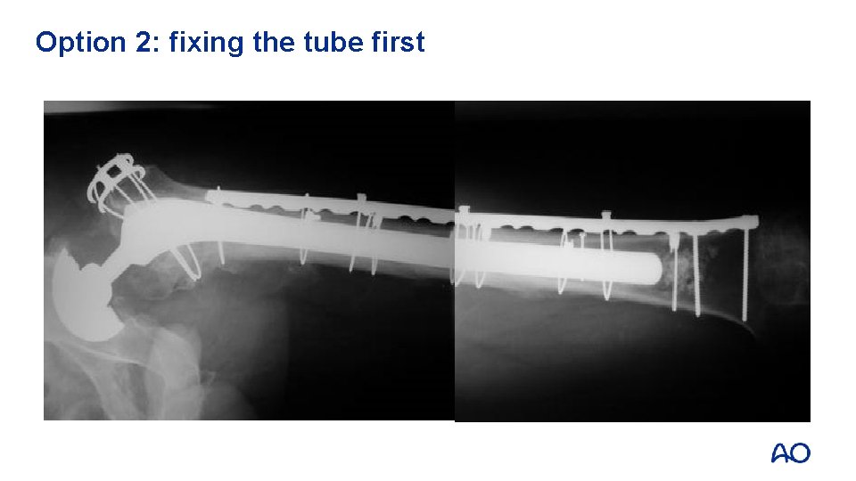 Option 2: fixing the tube first 