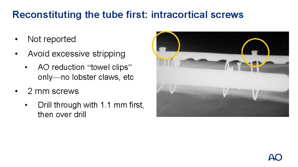 Reconstituting the tube first: intracortical screws • Not reported • Avoid excessive stripping •