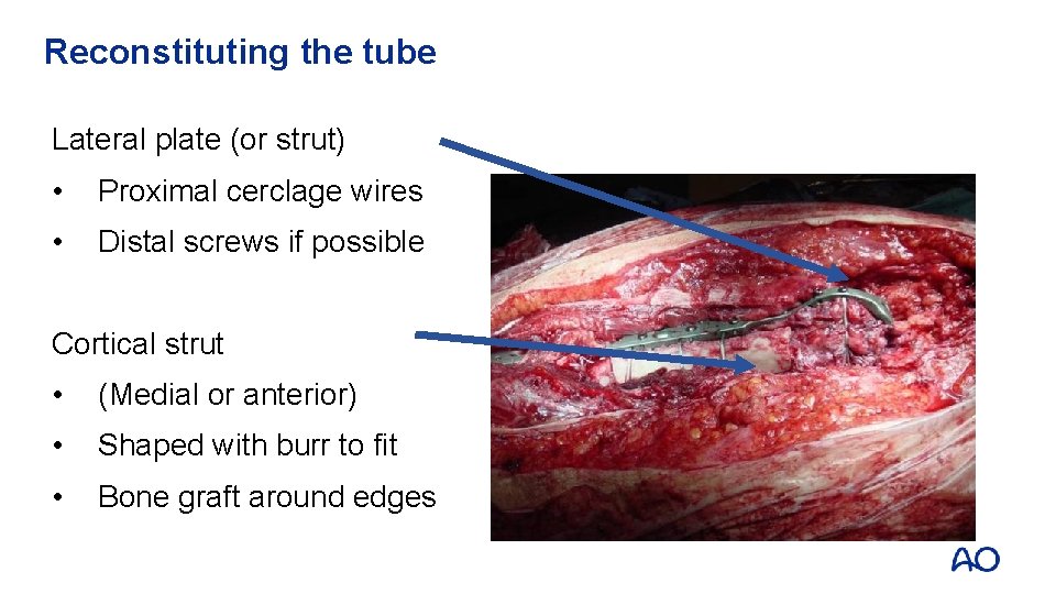 Reconstituting the tube Lateral plate (or strut) • Proximal cerclage wires • Distal screws