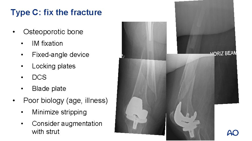 Type C: fix the fracture • • Osteoporotic bone • IM fixation • Fixed-angle
