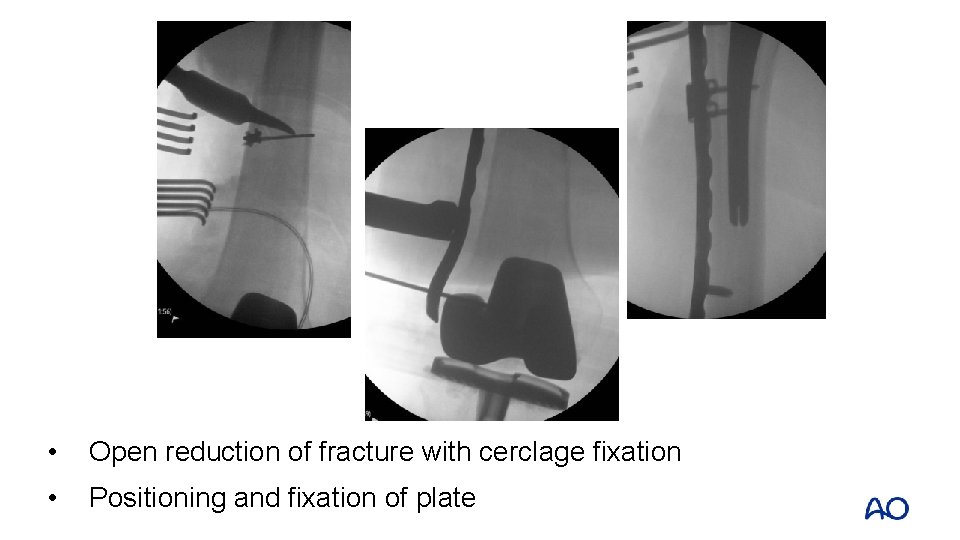  • Open reduction of fracture with cerclage fixation • Positioning and fixation of