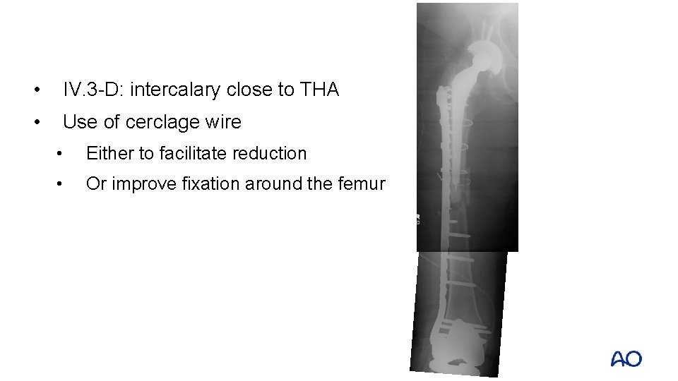  • IV. 3 -D: intercalary close to THA • Use of cerclage wire