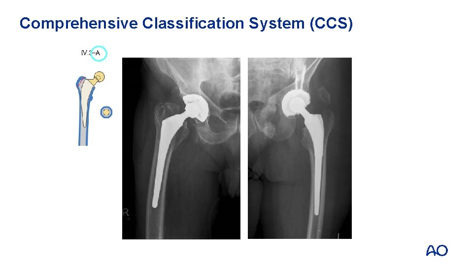 Comprehensive Classification System (CCS) IV. 3 -A 