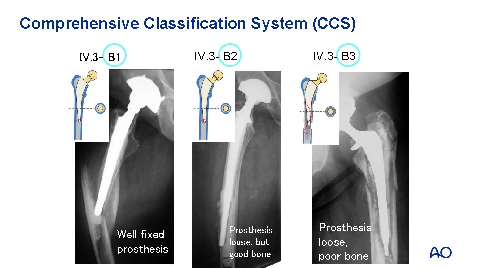 Comprehensive Classification System (CCS) IV. 3 - B 1 Well fixed prosthesis IV. 3