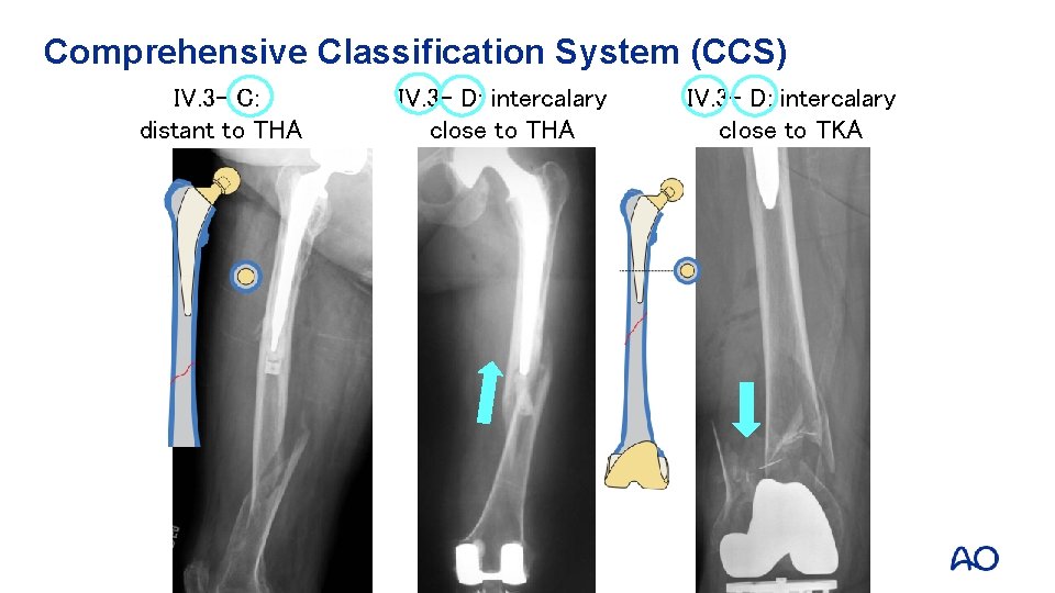 Comprehensive Classification System (CCS) IV. 3 - C: distant to THA IV. 3 -