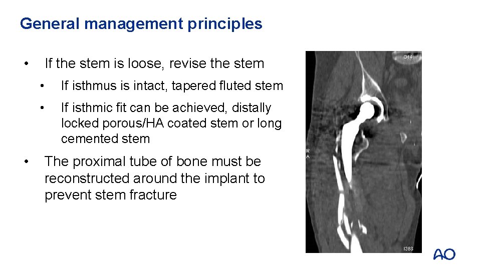 General management principles • • If the stem is loose, revise the stem •