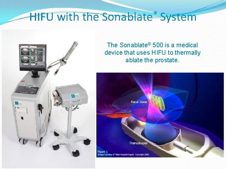 HIFU with the Sonablate® System The Sonablate® 500 is a medical device that uses