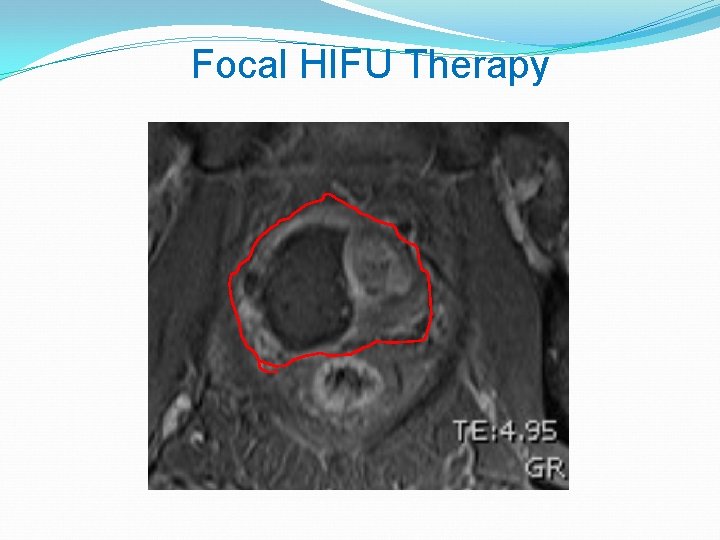 Focal HIFU Therapy 