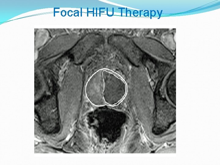 Focal HIFU Therapy 