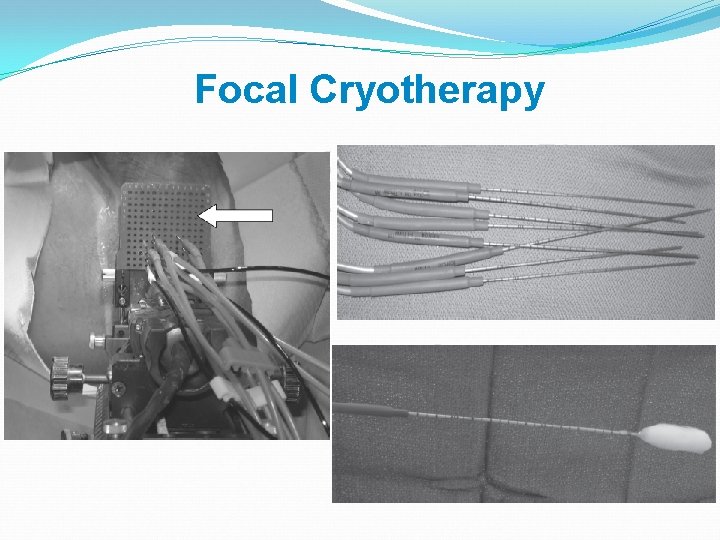 Focal Cryotherapy 