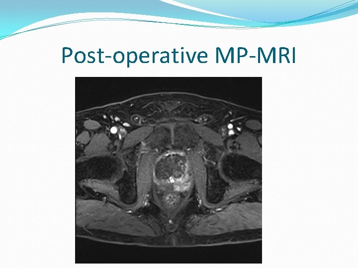 Post-operative MP-MRI 