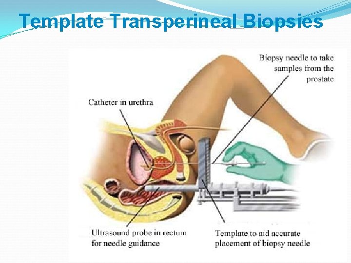 Template Transperineal Biopsies 