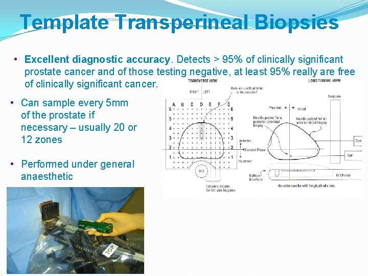 Template Transperineal Biopsies • Excellent diagnostic accuracy. Detects > 95% of clinically significant prostate