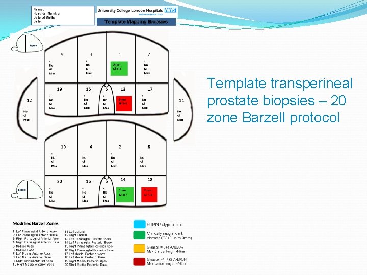 Template transperineal prostate biopsies – 20 zone Barzell protocol 