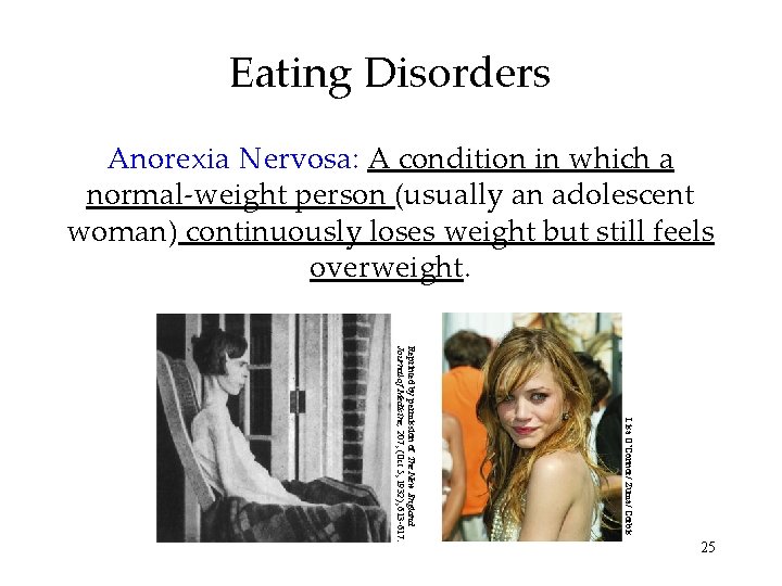 Eating Disorders Anorexia Nervosa: A condition in which a normal-weight person (usually an adolescent