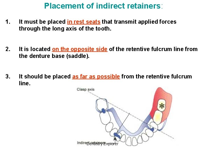 Placement of indirect retainers: 1. It must be placed in rest seats that transmit