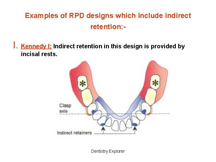 Examples of RPD designs which include indirect retention: - I. Kennedy I: Indirect retention