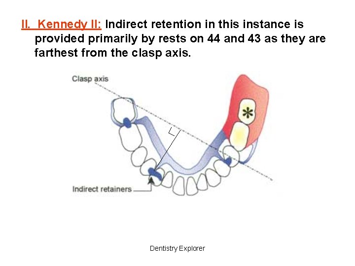 II. Kennedy II: Indirect retention in this instance is provided primarily by rests on