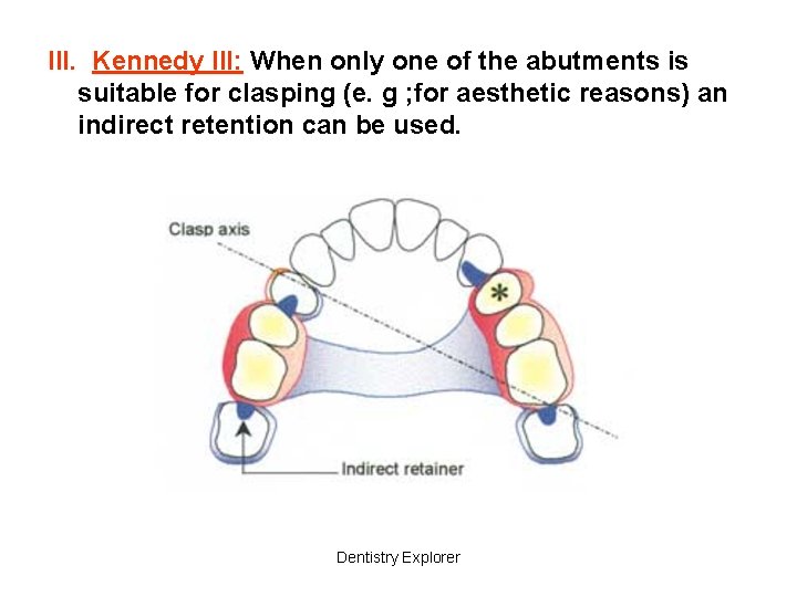 III. Kennedy III: When only one of the abutments is suitable for clasping (e.