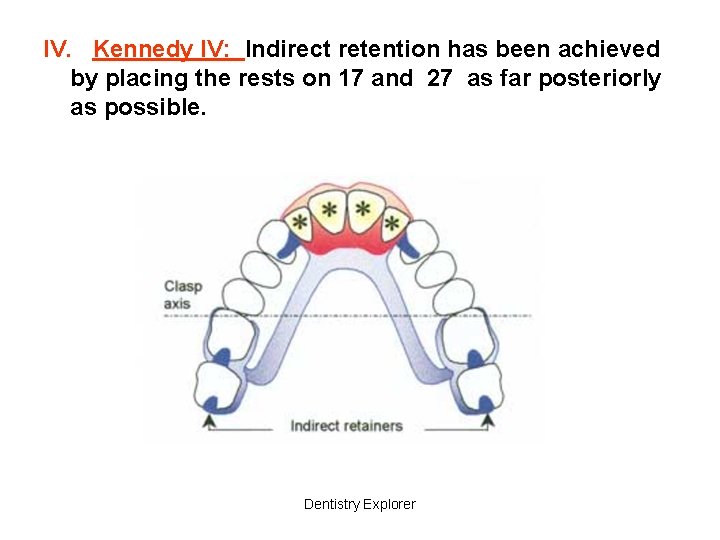 IV. Kennedy IV: Indirect retention has been achieved by placing the rests on 17