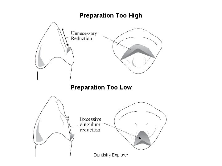 Preparation Too High Preparation Too Low Dentistry Explorer 