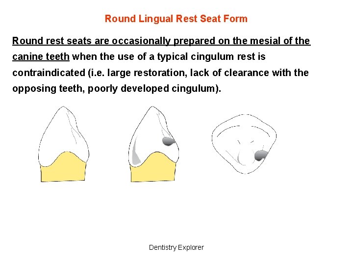 Round Lingual Rest Seat Form Round rest seats are occasionally prepared on the mesial