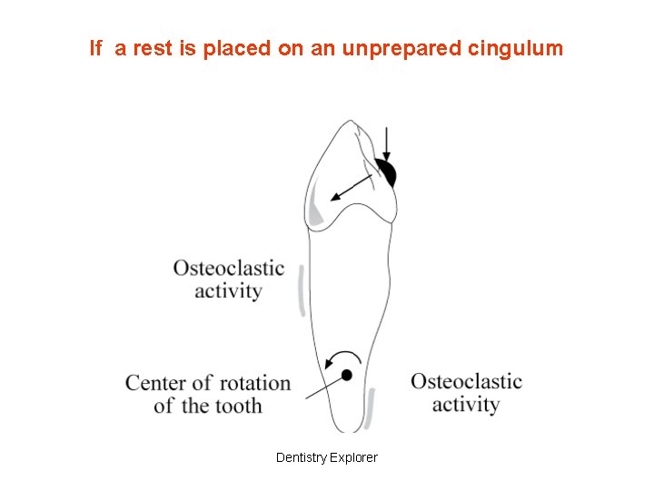 If a rest is placed on an unprepared cingulum Dentistry Explorer 