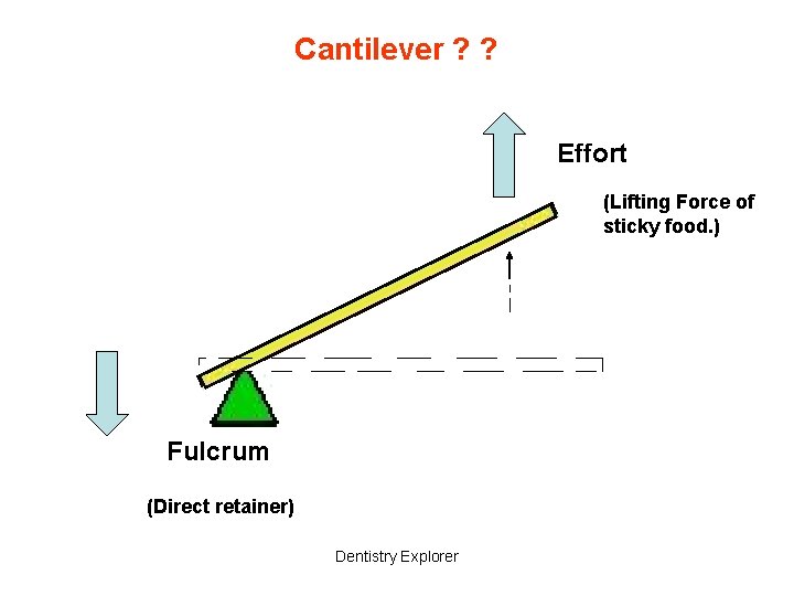 Cantilever ? ? Effort (Lifting Force of sticky food. ) Fulcrum (Direct retainer) Dentistry