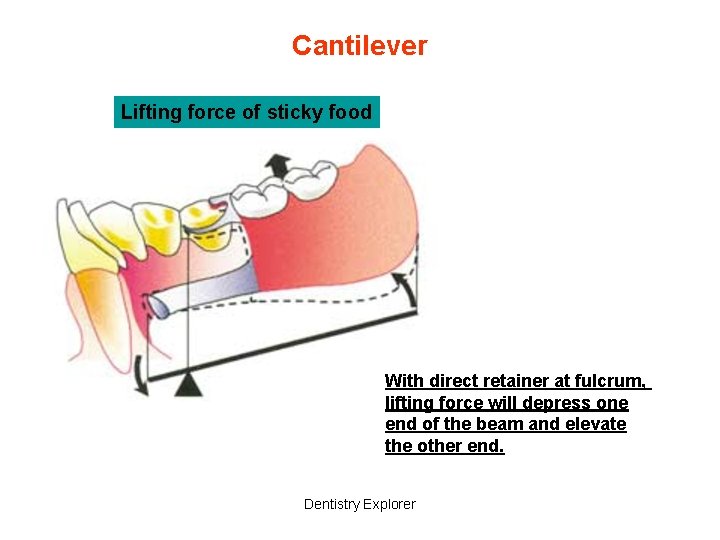 Cantilever Lifting force of sticky food With direct retainer at fulcrum, lifting force will