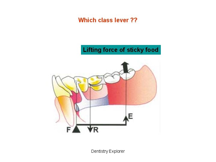 Which class lever ? ? Lifting force of sticky food Dentistry Explorer 
