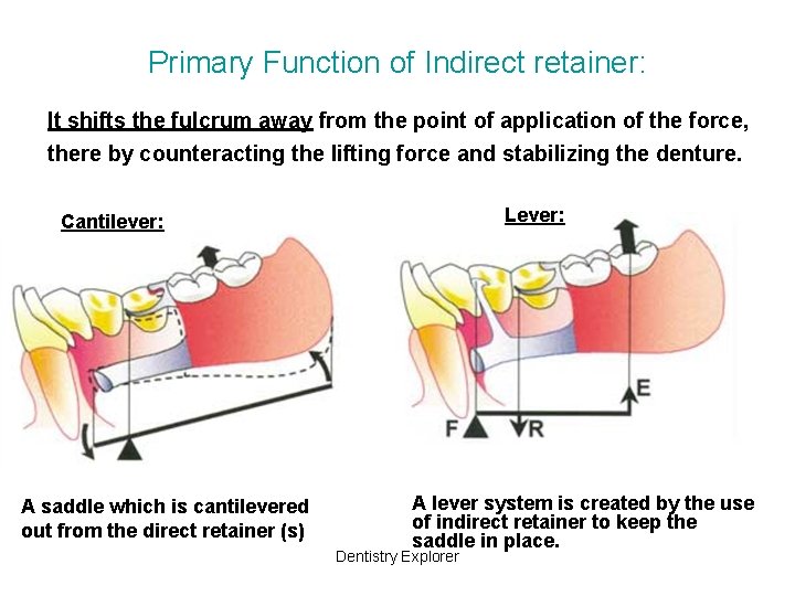 Primary Function of Indirect retainer: It shifts the fulcrum away from the point of