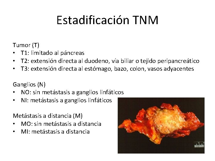 Estadificación TNM Tumor (T) • T 1: limitado al páncreas • T 2: extensión