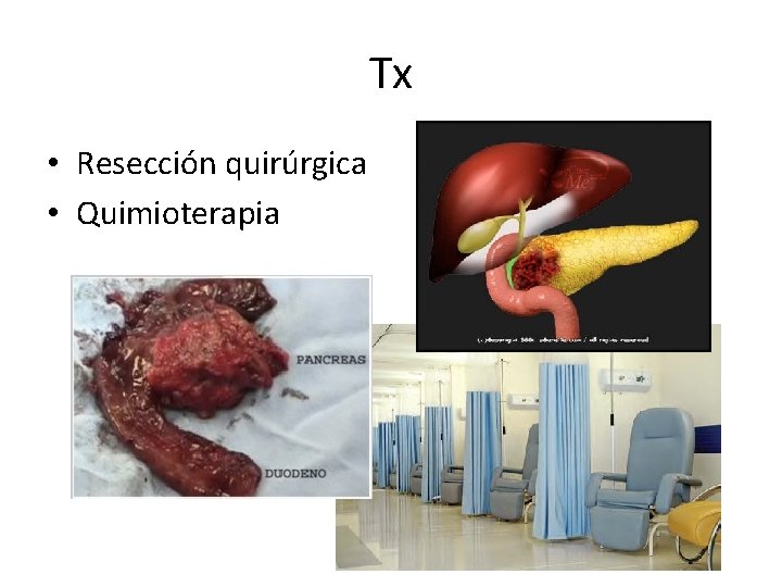 Tx • Resección quirúrgica • Quimioterapia 