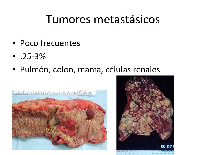 Tumores metastásicos • Poco frecuentes • . 25 -3% • Pulmón, colon, mama, células