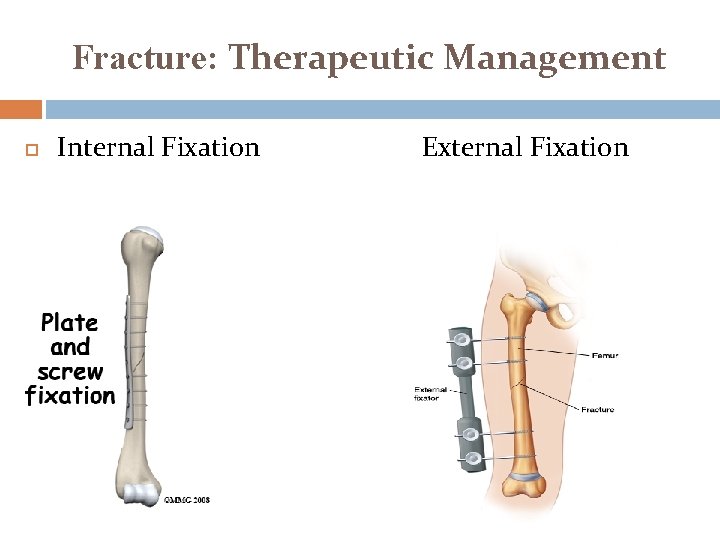Fracture: Therapeutic Management Internal Fixation External Fixation Fracture: Therapeutic Management Internal Fixation External Fixation