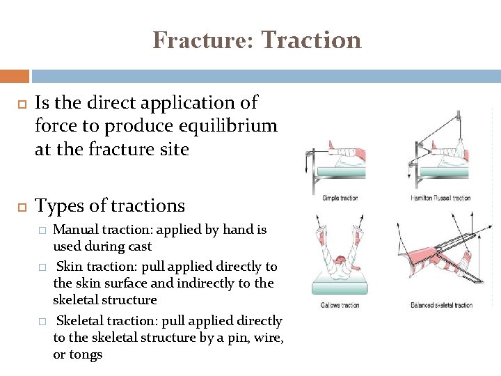Fracture: Traction Is the direct application of force to produce equilibrium at the fracture