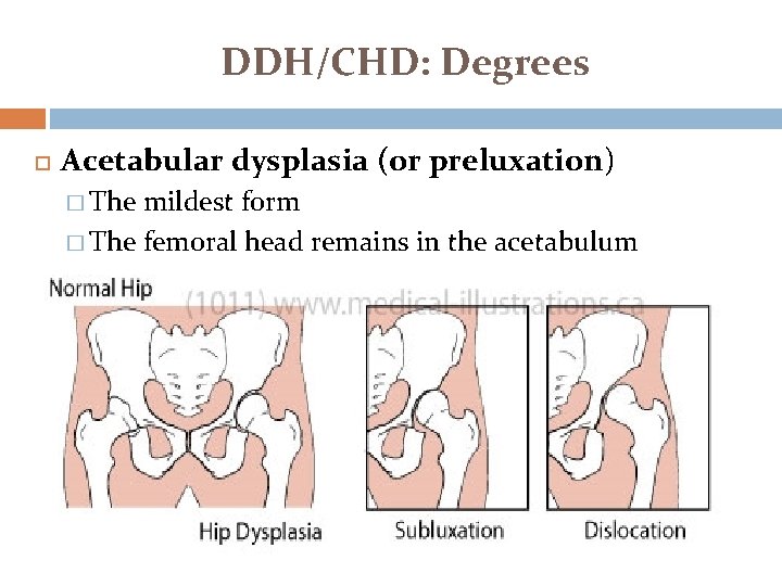 DDH/CHD: Degrees Acetabular dysplasia (or preluxation) � The mildest form � The femoral head DDH/CHD: Degrees Acetabular dysplasia (or preluxation) � The mildest form � The femoral head