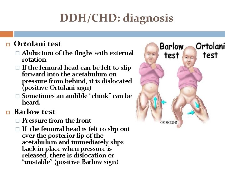 DDH/CHD: diagnosis Ortolani test Abduction of the thighs with external rotation. � If the DDH/CHD: diagnosis Ortolani test Abduction of the thighs with external rotation. � If the
