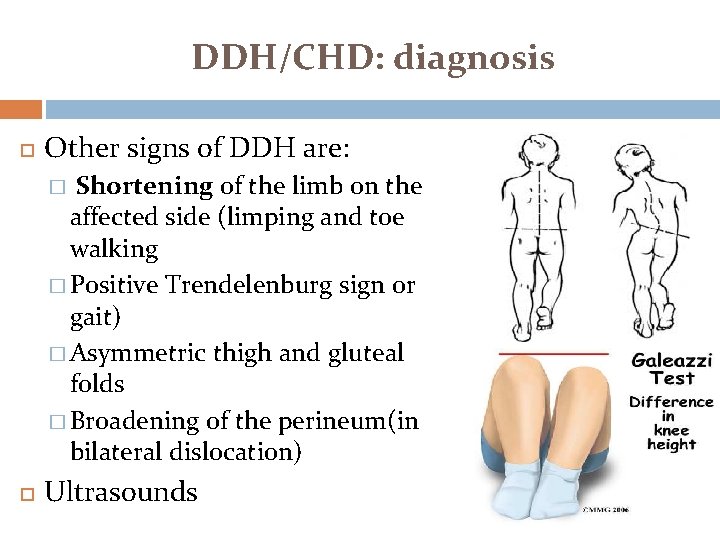 DDH/CHD: diagnosis Other signs of DDH are: Shortening of the limb on the affected