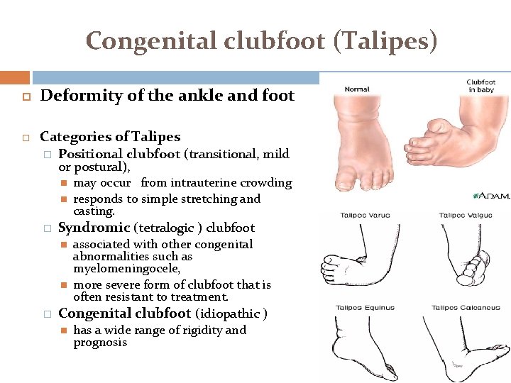 Congenital clubfoot (Talipes) Deformity of the ankle and foot Categories of Talipes � Positional Congenital clubfoot (Talipes) Deformity of the ankle and foot Categories of Talipes � Positional