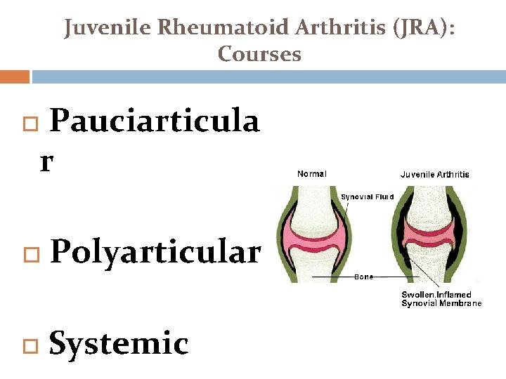Juvenile Rheumatoid Arthritis (JRA): Courses Pauciarticula r Polyarticular Systemic 