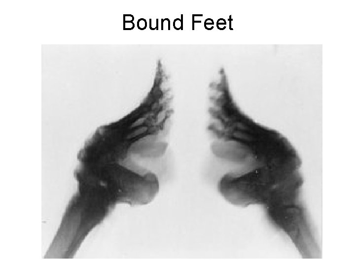 Bound Feet 